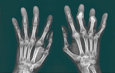 Rheumatoide Arthritis: Neue Behandlungsmöglichkeiten 