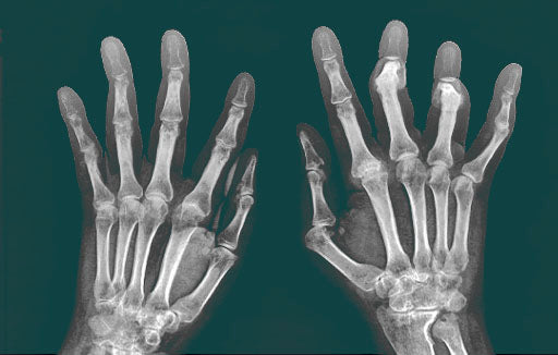 Rheumatoid Arthritis: New Therapy Avenues